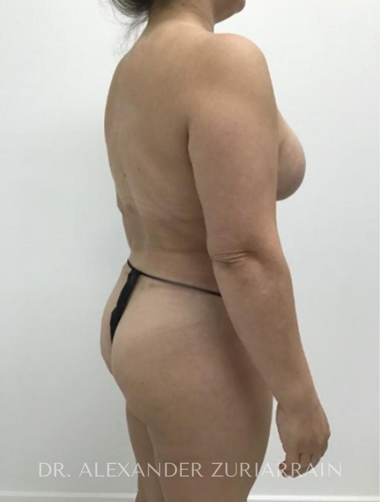 Mommy makeover before & after photo