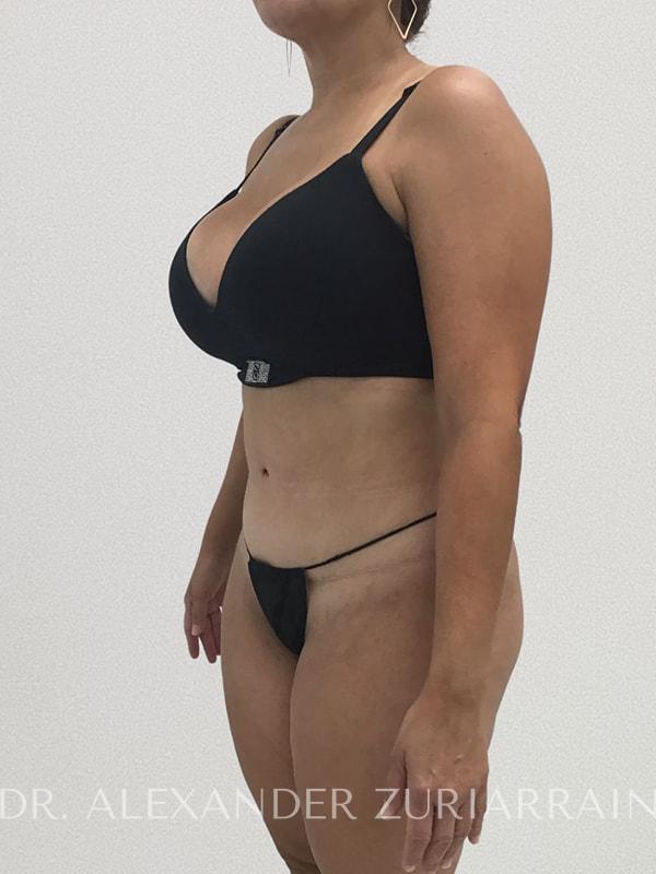 Mommy makeover before & after photo