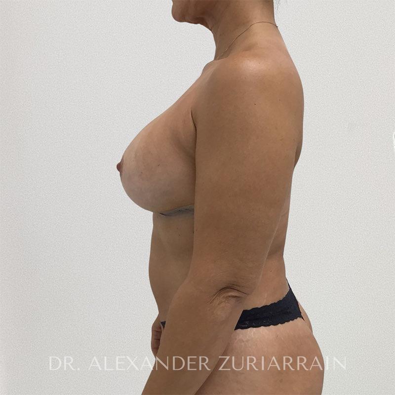 Reverse tummy tuck before & after photo