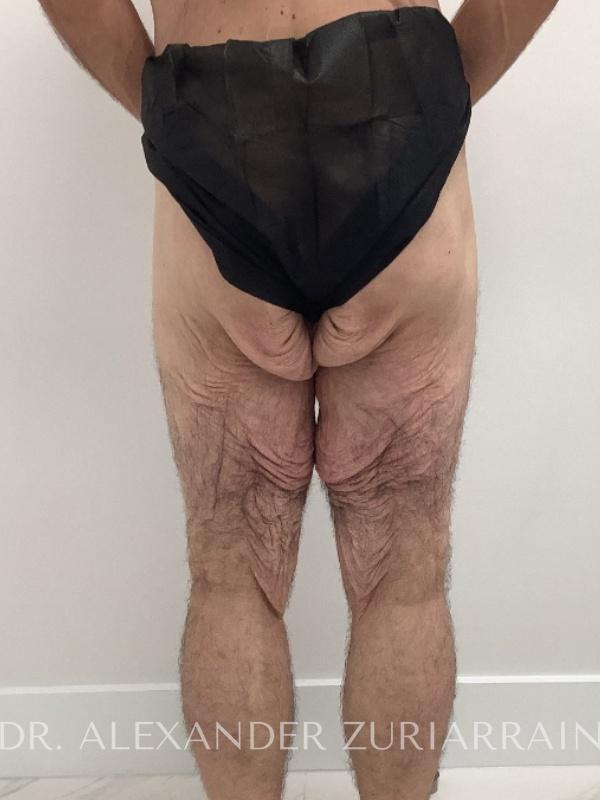 Thigh lift before & after photo
