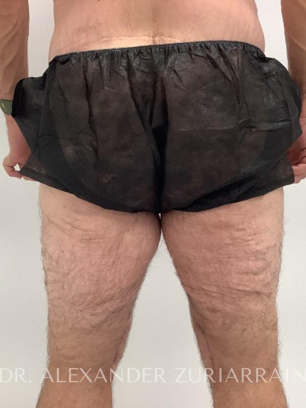 Thigh lift before & after photo