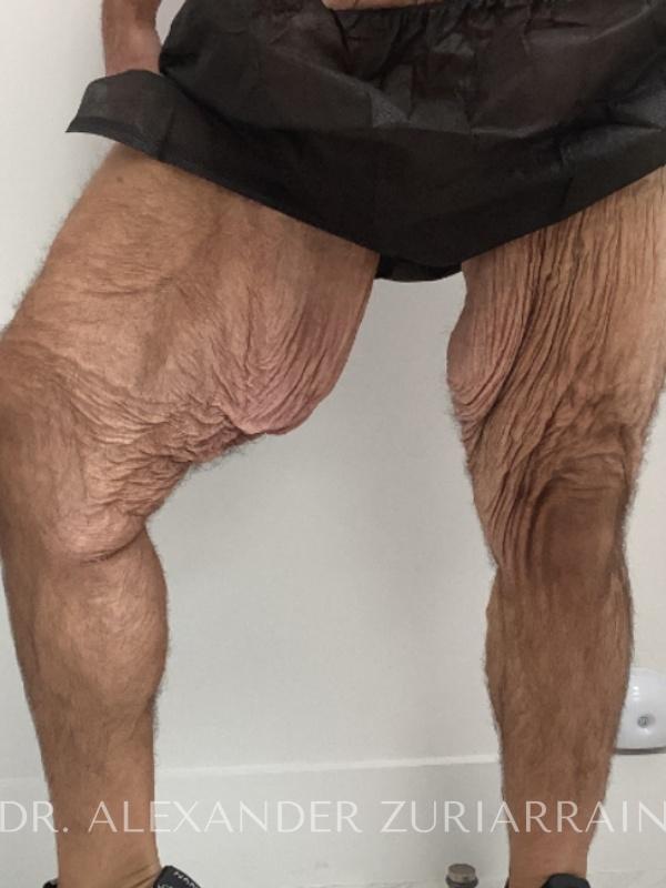 Thigh lift before & after photo