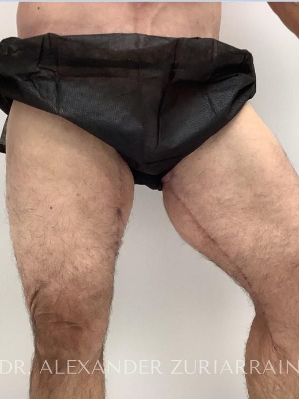 Thigh lift before & after photo