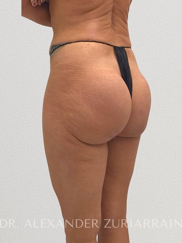 Thong lift before & after photo