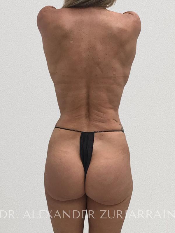Thong lift before & after photo