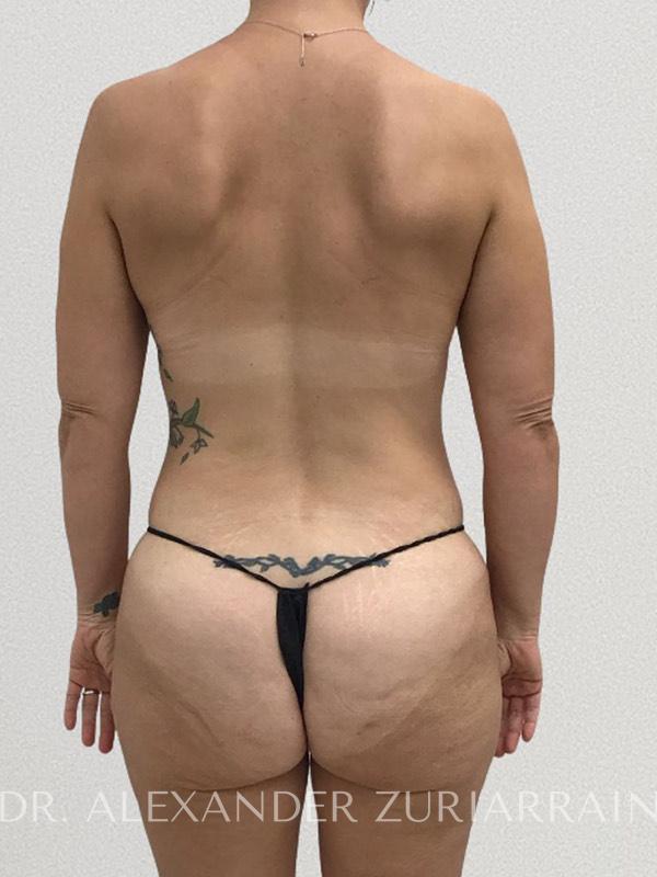 Thong lift before & after photo