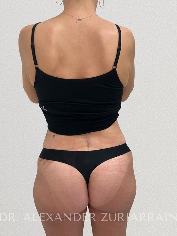 Thong lift before & after photo