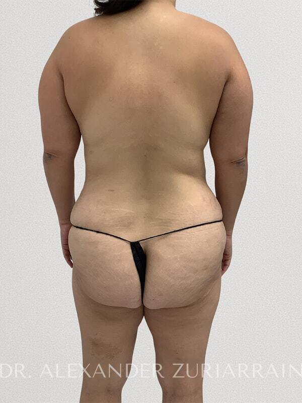 Thong lift before & after photo