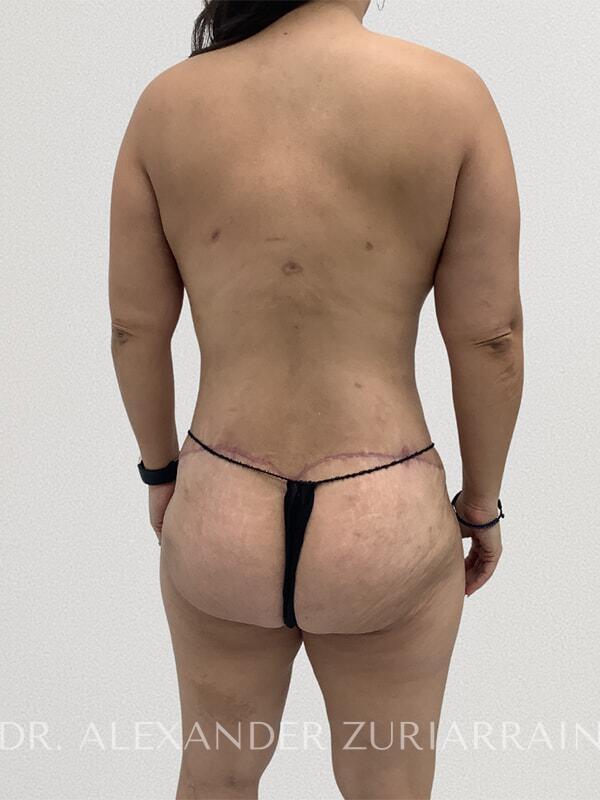 Thong lift before & after photo