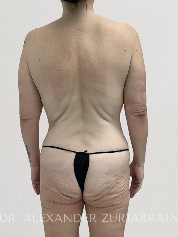 Thong lift before & after photo