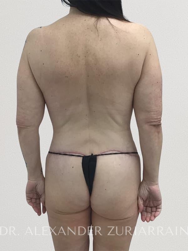 Thong lift before & after photo