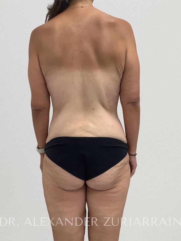 Thong lift before & after photo