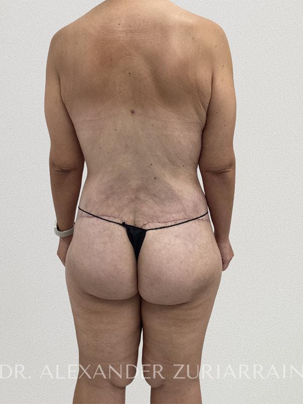 Thong lift before & after photo