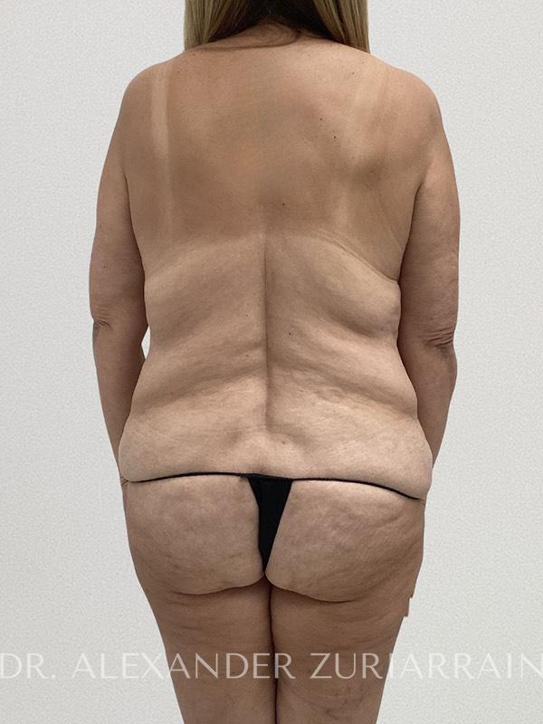 Thong lift before & after photo