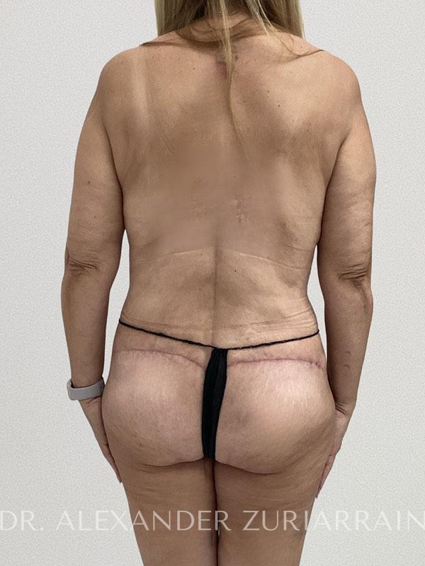 Thong lift before & after photo