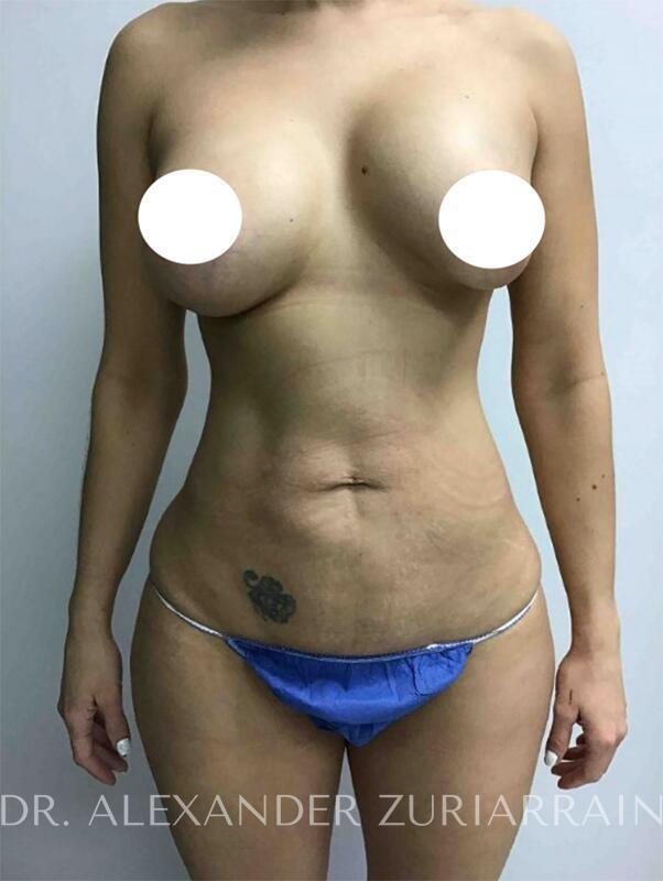 Tummy tuck before & after photo