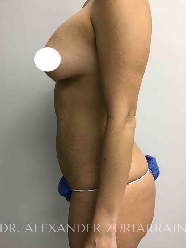 Tummy tuck before & after photo