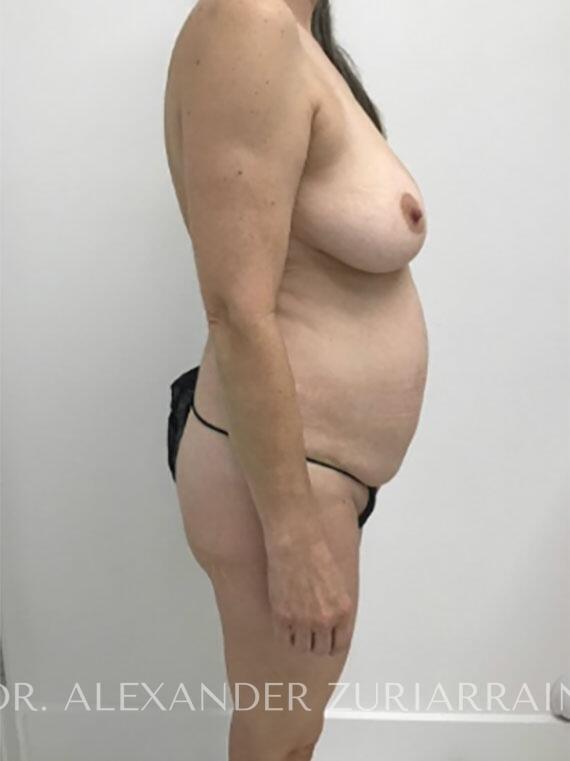 Tummy tuck before & after photo