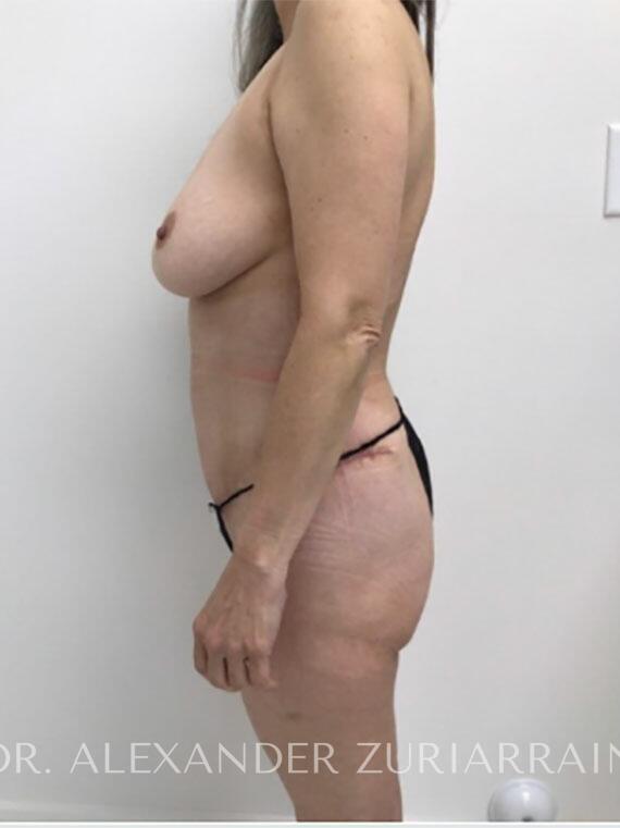 Tummy tuck before & after photo