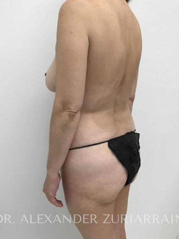 Tummy tuck before & after photo