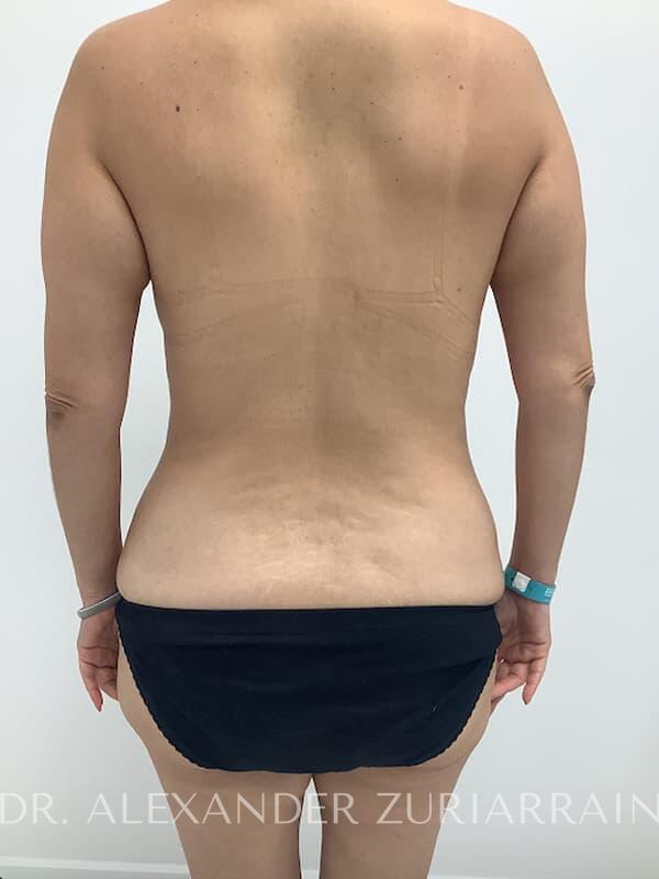 Tummy tuck before & after photo