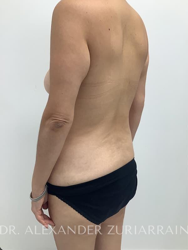 Tummy tuck before & after photo