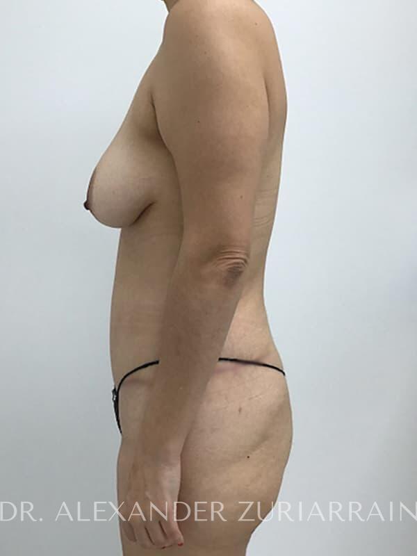 Tummy tuck before & after photo