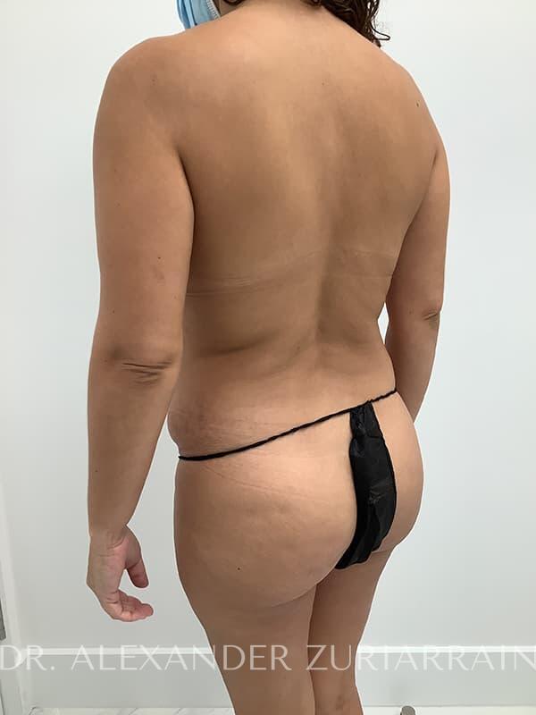 Tummy tuck before & after photo