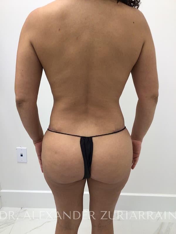 Tummy tuck before & after photo