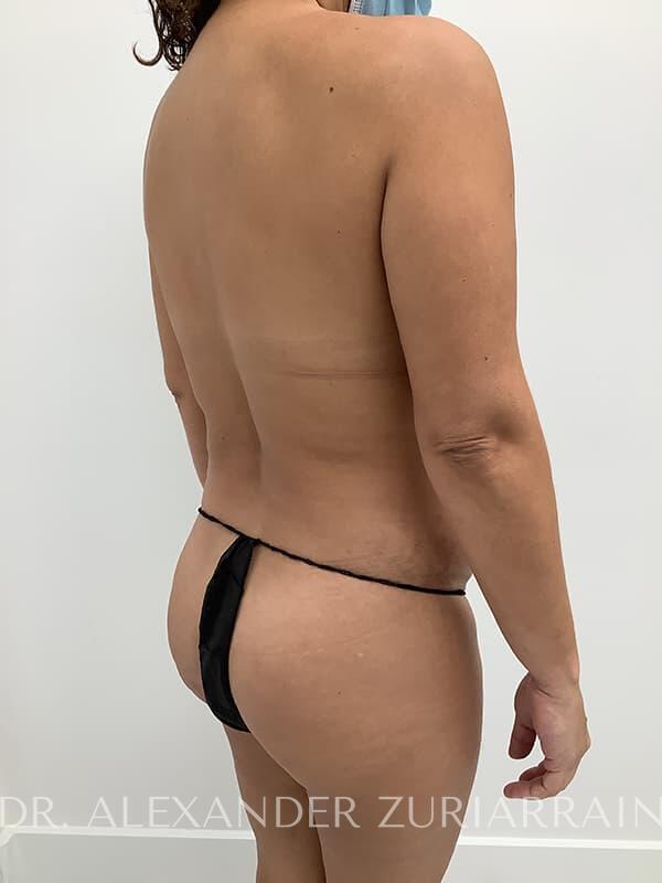 Tummy tuck before & after photo