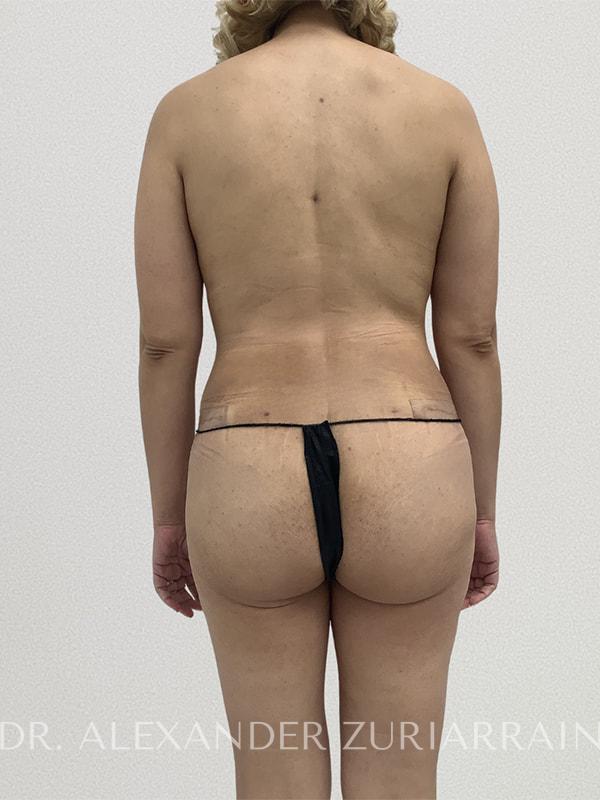 Tummy tuck before & after photo