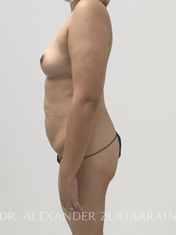 Tummy tuck before & after photo