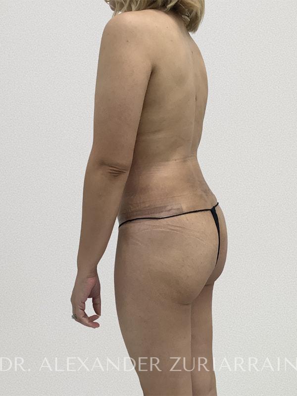 Tummy tuck before & after photo