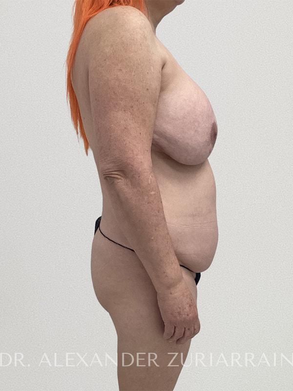 Tummy tuck before & after photo