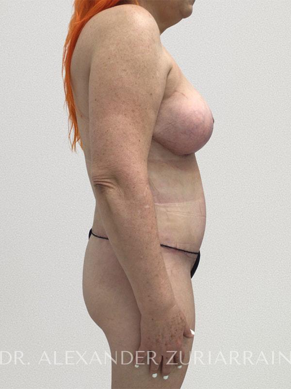 Tummy tuck before & after photo