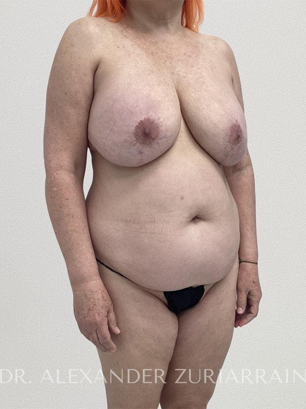 Tummy tuck before & after photo
