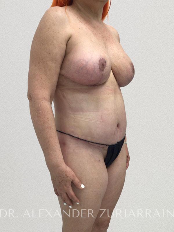 Tummy tuck before & after photo