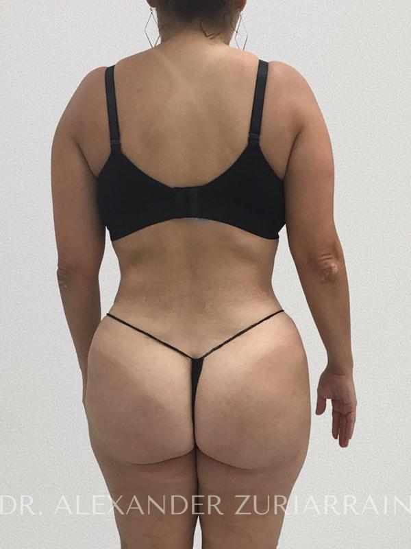 Tummy tuck before & after photo