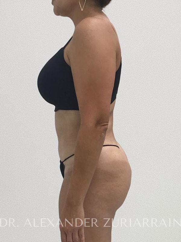 Tummy tuck before & after photo