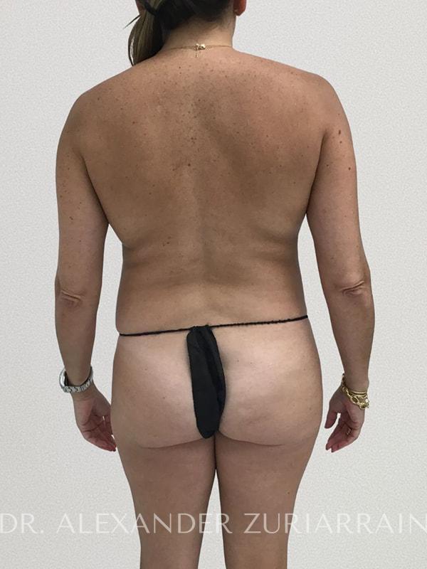 Tummy tuck before & after photo