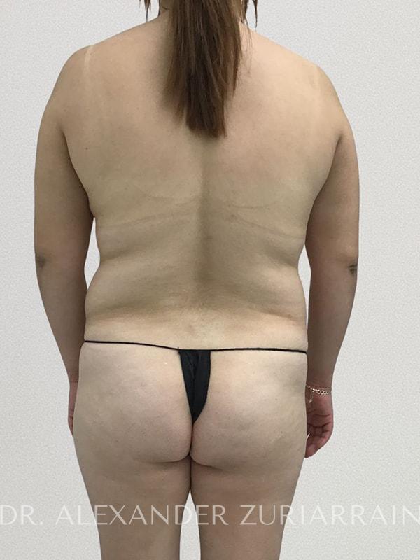Tummy tuck before & after photo