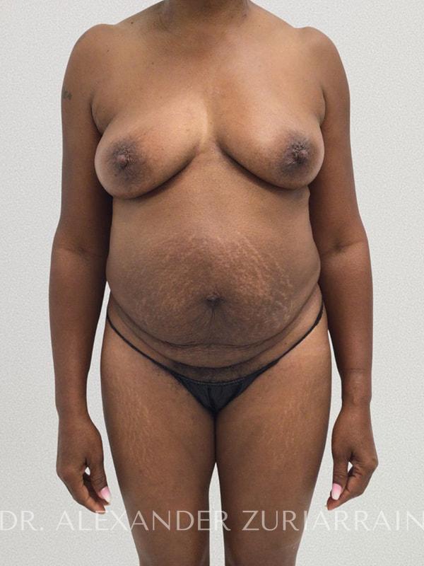 Tummy tuck before & after photo