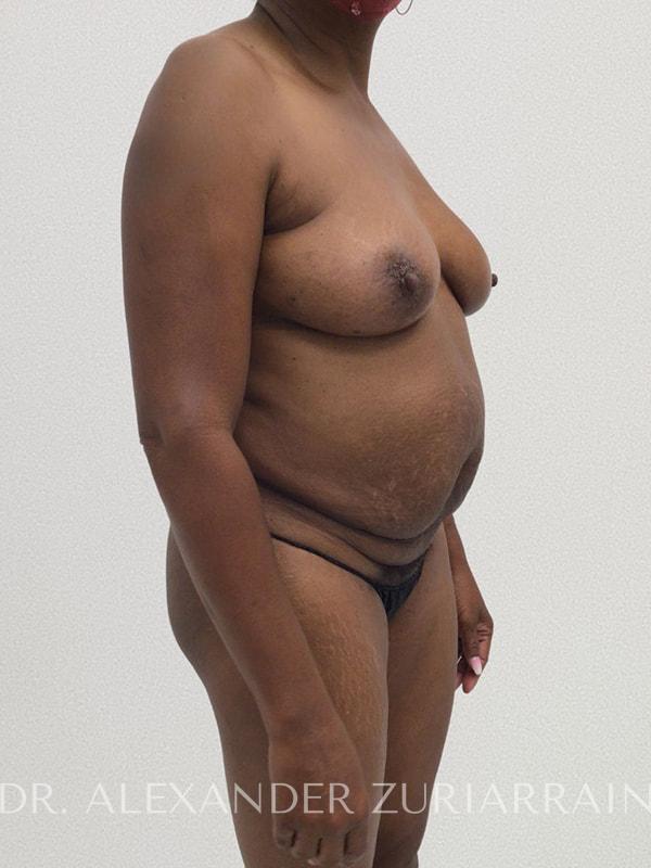 Tummy tuck before & after photo