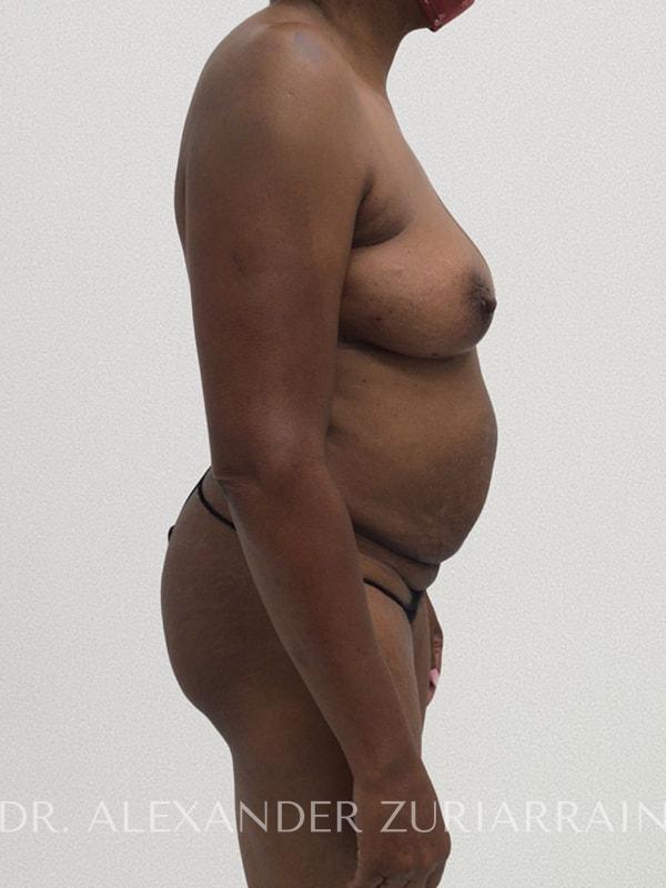 Tummy tuck before & after photo