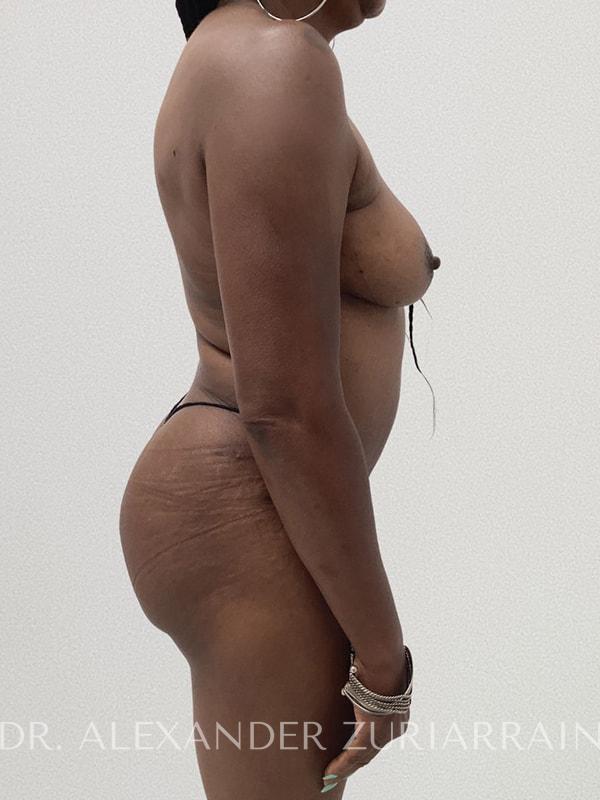 Tummy tuck before & after photo