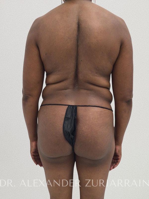 Tummy tuck before & after photo