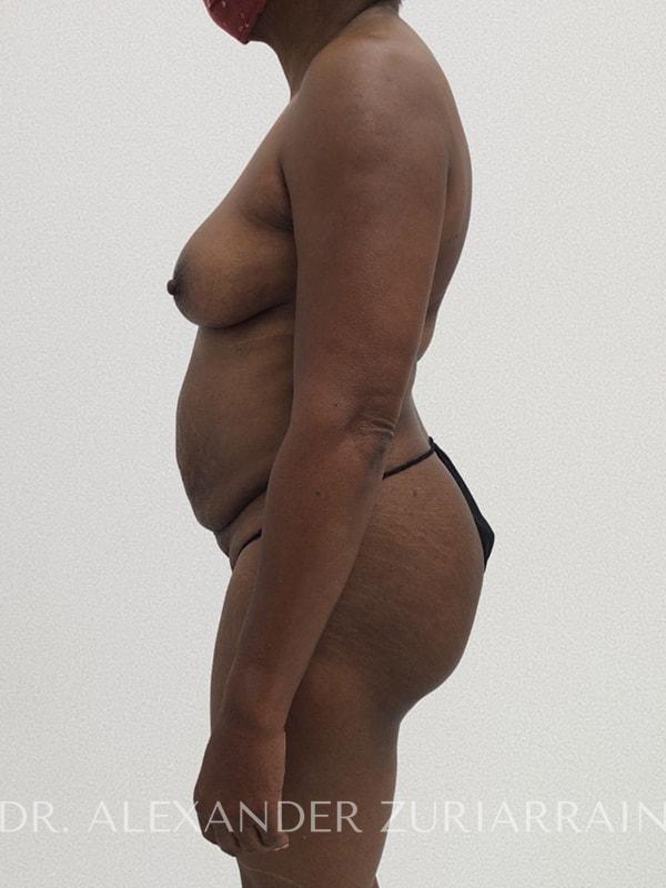 Tummy tuck before & after photo