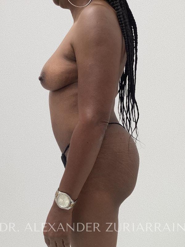 Tummy tuck before & after photo