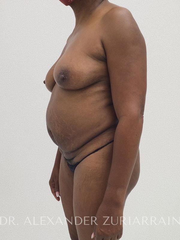 Tummy tuck before & after photo