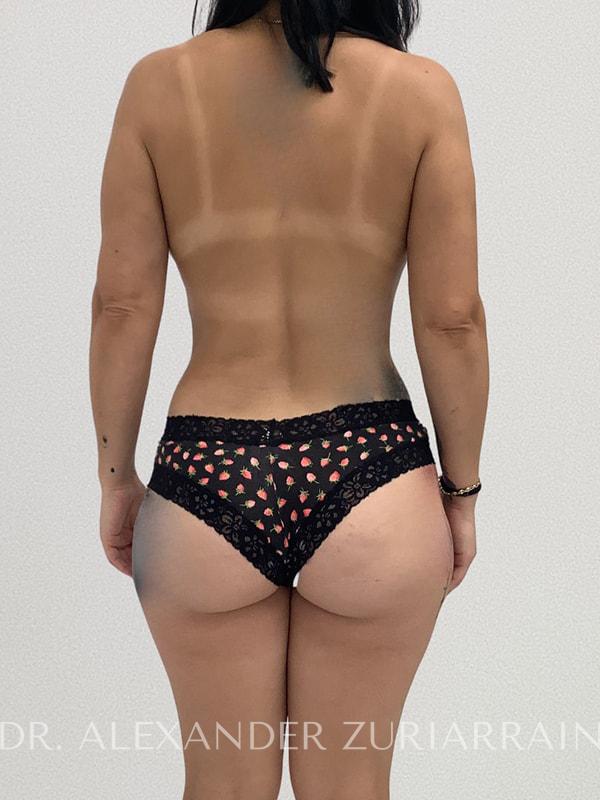 Tummy tuck before & after photo